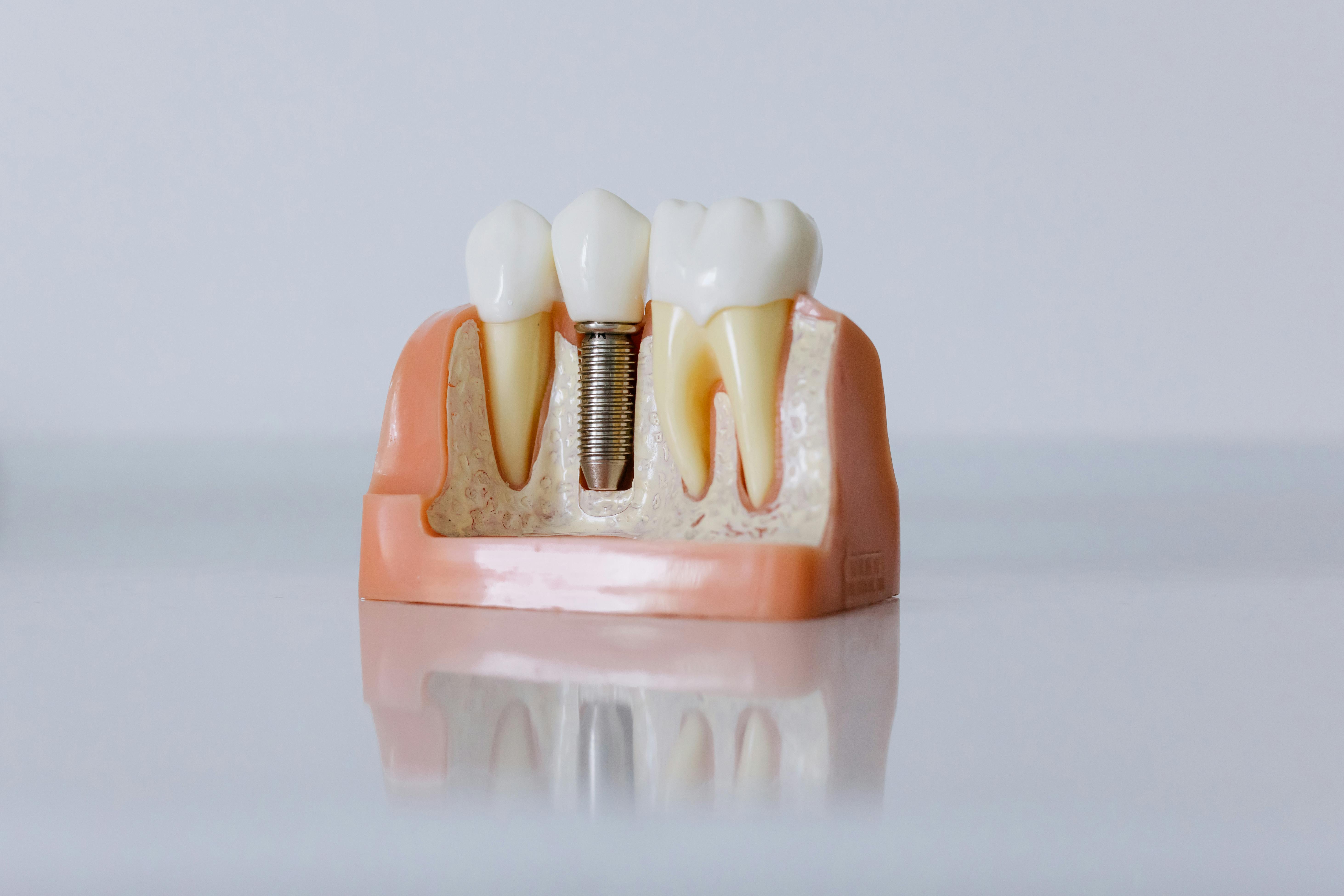Dental implant model